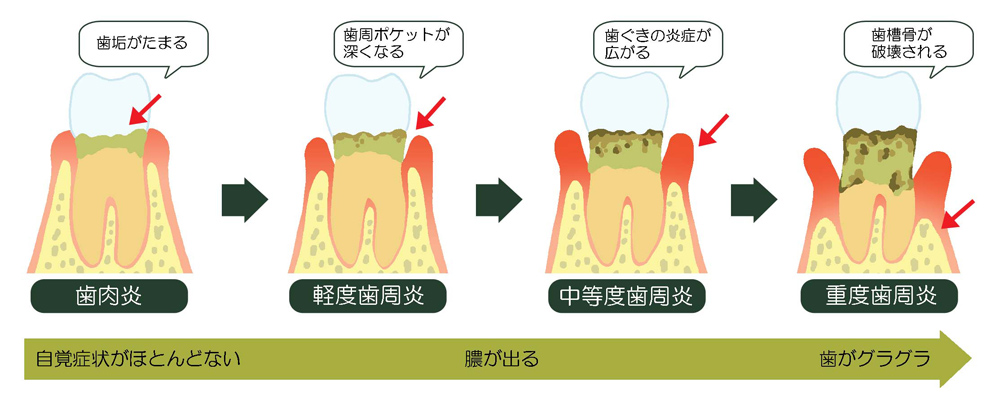 歯周病進行の段階説明